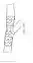 Fig. 34 - Support for treating vascular bifurcations