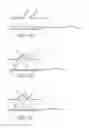 Fig. 35 - Support for treating vascular bifurcations
