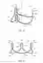 Fig. 03 - Stented prosthetic heart valve