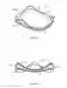 Fig. 12 - Stented prosthetic heart valve