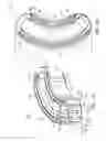 Fig. 02 - Intervertebral Body Implant, Instrument and Method