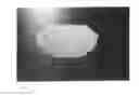 Fig. 04 - Artificial Perforated Tarsorrhaphy