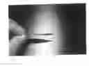Fig. 07 - Artificial Perforated Tarsorrhaphy