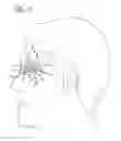 Fig. 08 - Artificial Perforated Tarsorrhaphy
