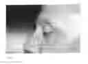 Fig. 09 - Artificial Perforated Tarsorrhaphy
