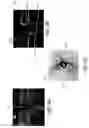 Fig. 09 - Automated assessment of glaucoma loss from optical coherence tomography