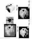Fig. 22 - Automated assessment of glaucoma loss from optical coherence tomography