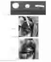 Fig. 04 - BONE FILLER MATERIAL AND METHODS OF USE