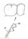 Fig. 01 - Device for fixation at a dental site