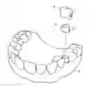 Fig. 01 - SPRING CLIP MOUNTED TO WITHDRAWABLE ARTIFICIAL TOOTH AND REMOVABLE ARTIFICIAL TOOTH ASSEMBLED WITH SAME