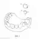 Fig. 02 - SPRING CLIP MOUNTED TO WITHDRAWABLE ARTIFICIAL TOOTH AND REMOVABLE ARTIFICIAL TOOTH ASSEMBLED WITH SAME