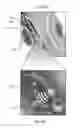 Fig. 04 - Wearable ultrasonic device for circulating tumor cell detection