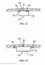 Fig. 13 - Catheter Apparatuses Having Expandable Mesh Structures for Renal Neuromodulation and Associated Systems and Methods