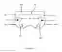 Fig. 06 - Sternal closure and ribs approximator devices
