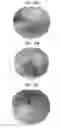 Fig. 23 - Flexible ACL instrumentation, kit and method