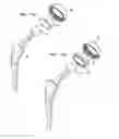 Fig. 13 - Pneumatic surgical instrument and corresponding methods for implanting, extracting and reorienting orthopedic implants