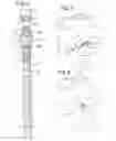 Fig. 03 - Minimally invasive spinal facet compression screw and system for bone joint fusion and fixation