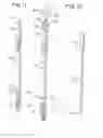 Fig. 06 - Minimally invasive spinal facet compression screw and system for bone joint fusion and fixation