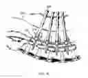 Fig. 06 - Bone screw of minimally invasive fixation device for lumbar
