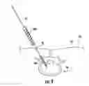 Fig. 07 - Surgical system, device, and method for implanting a surgical device without the use of a guide wire