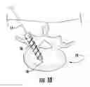Fig. 08 - Surgical system, device, and method for implanting a surgical device without the use of a guide wire
