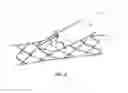 Fig. 10 - Bifurcated stent and delivery system
