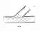 Fig. 11 - Bifurcated stent and delivery system