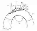 Fig. 01 - Stent graft