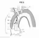 Fig. 04 - Stent graft