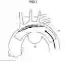 Fig. 08 - Stent graft
