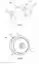 Fig. 36 - Catheter system for introducing an expandable heart valve stent into the body of a patient