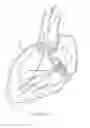 Fig. 10 - Systems and methods for delivering a medical implant