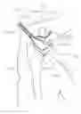 Fig. 01 - IN-SITU FORMATION OF A JOINT REPLACEMENT PROSTHESIS