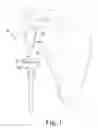 Fig. 02 - Method of implanting a reverse shoulder orthopaedic implant having a metaglene component with a screw locking cap