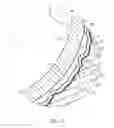 Fig. 06 - Deforming implant-bone interface