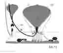 Fig. 07 - METHOD AND DEVICE FOR LIFTING AN OBJECT FROM THE SEA FLOOR