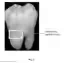Fig. 06 - Compositions containing theobromine and their use in treating tooth hypersensitivity