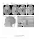 Fig. 04 - Compositions and methods for diagnosing and treating meningioma