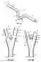 Fig. 05 - Bifurcated outflow cannulae