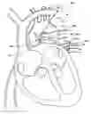 Fig. 01 - Ventricular assist device and related methods