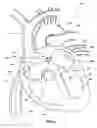 Fig. 05 - Ventricular assist device and related methods