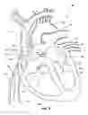 Fig. 06 - Ventricular assist device and related methods