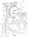 Fig. 07 - Ventricular assist device and related methods