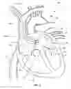 Fig. 10 - Ventricular assist device and related methods