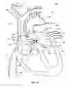 Fig. 15 - Ventricular assist device and related methods