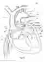 Fig. 16 - Ventricular assist device and related methods