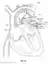Fig. 17 - Ventricular assist device and related methods