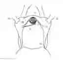 Fig. 01 - Stabilizer for the transvaginal placement of a midurethral sling