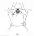 Fig. 02 - Stabilizer for the transvaginal placement of a midurethral sling