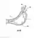 Fig. 26 - Devices and methods facilitating sleeve gastrectomy procedures